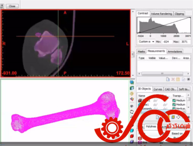 ویرایش لایه های تصویر Distal مدل استخوان های Tibia و Fibula در نرم افزار Mimics