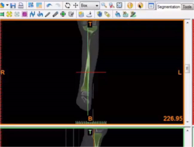 جداسازی ماسک استخوان Fibula از Tibia در نرم افزار mimics